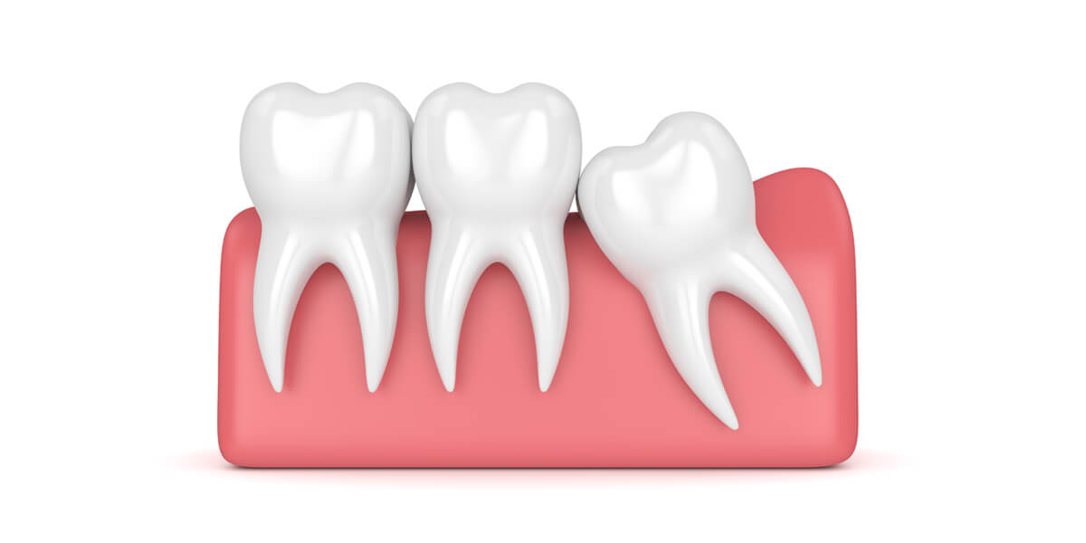 Exposure of an Impacted Tooth Sedaros Oral Surgery